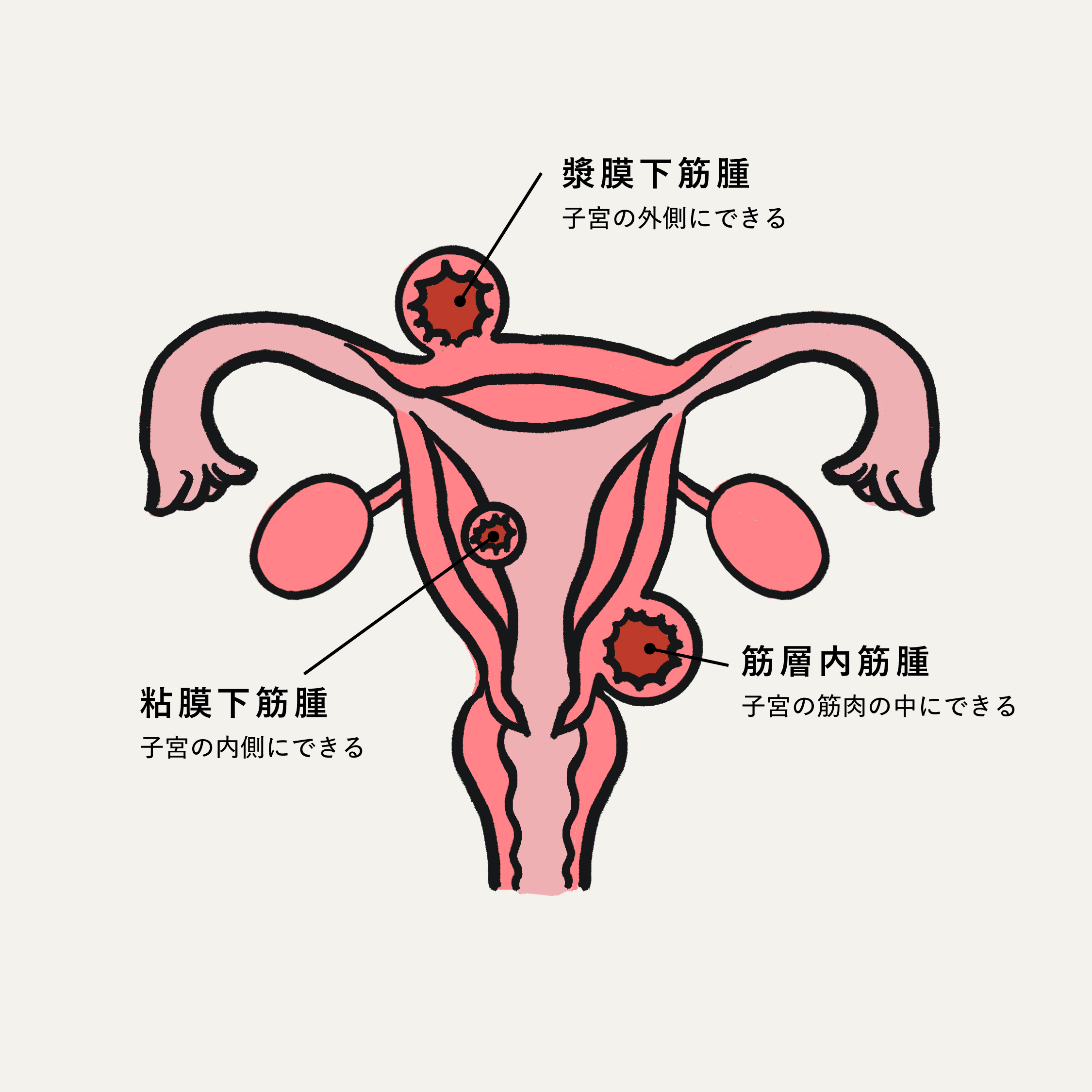 子宮筋腫の種類を示す図解(漿膜下筋腫・粘膜下筋腫・筋層内筋腫)