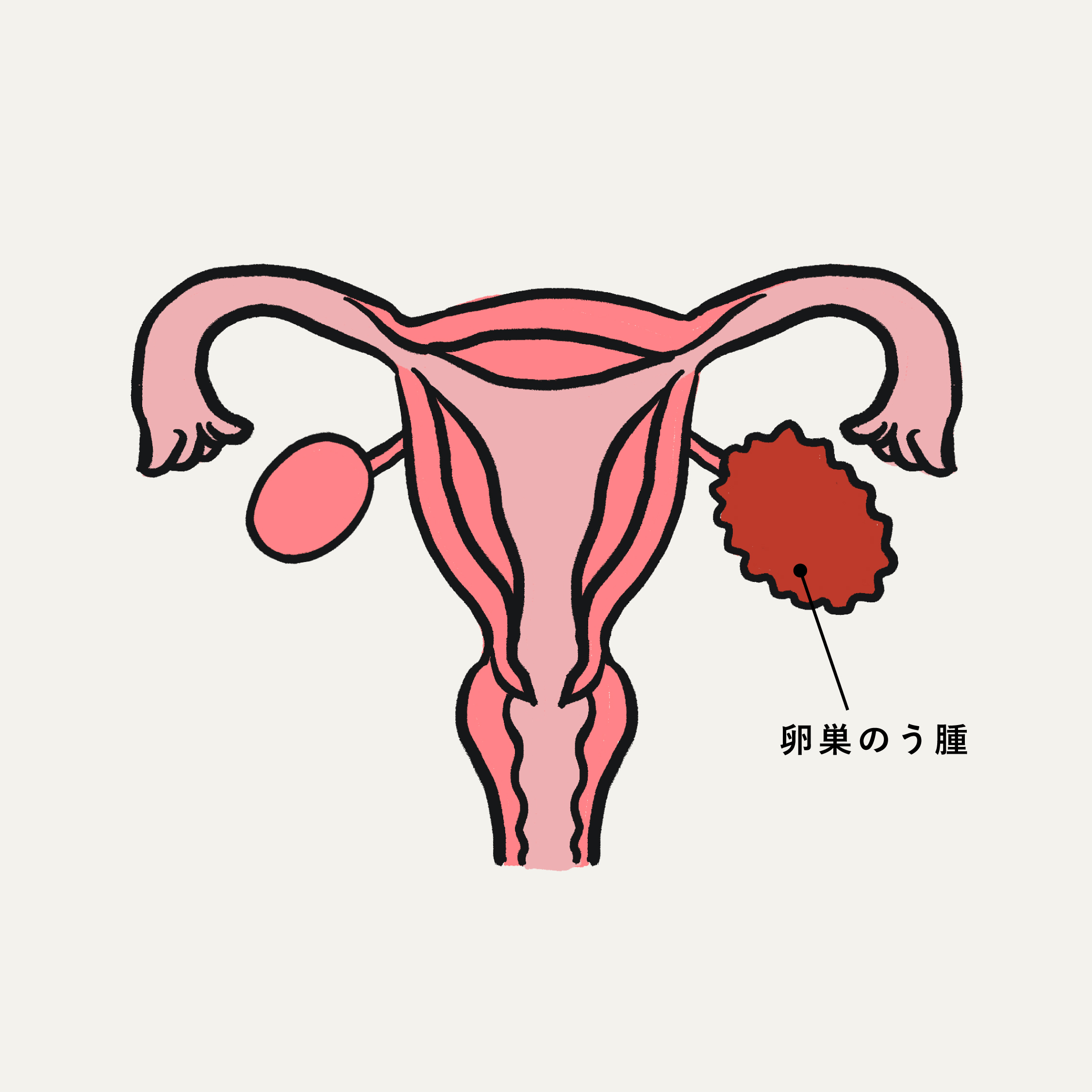 卵巣のう腫の位置を示した子宮と卵巣の医療イラスト