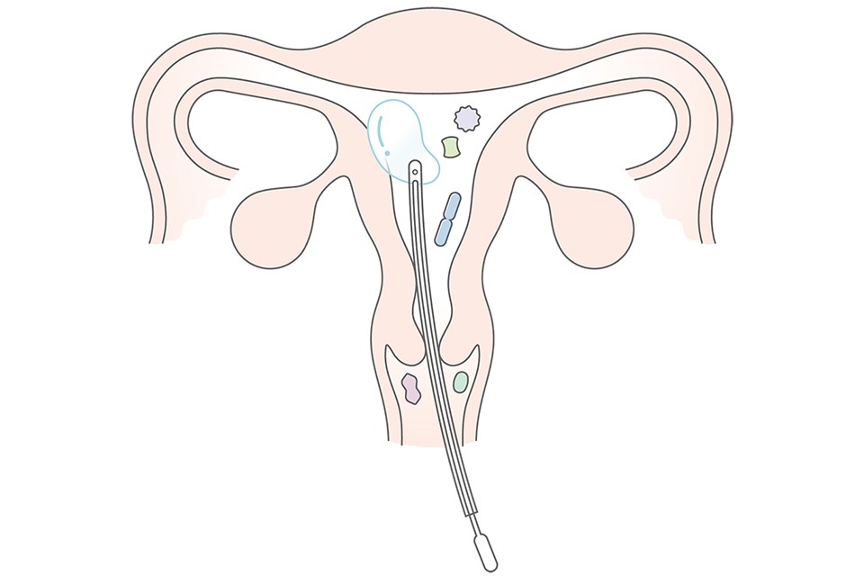 子宮内フローラ検査