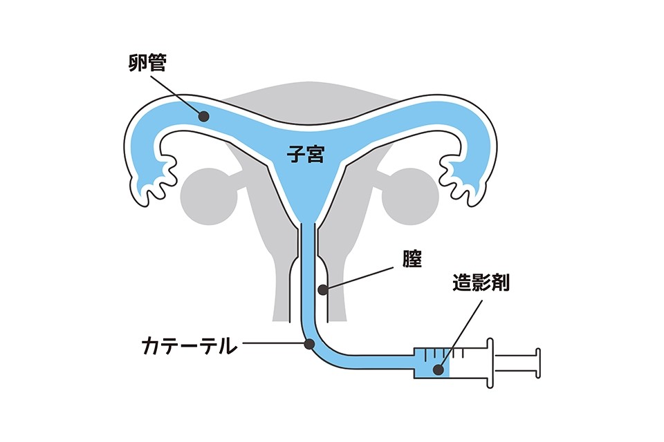 子宮卵管造影検査