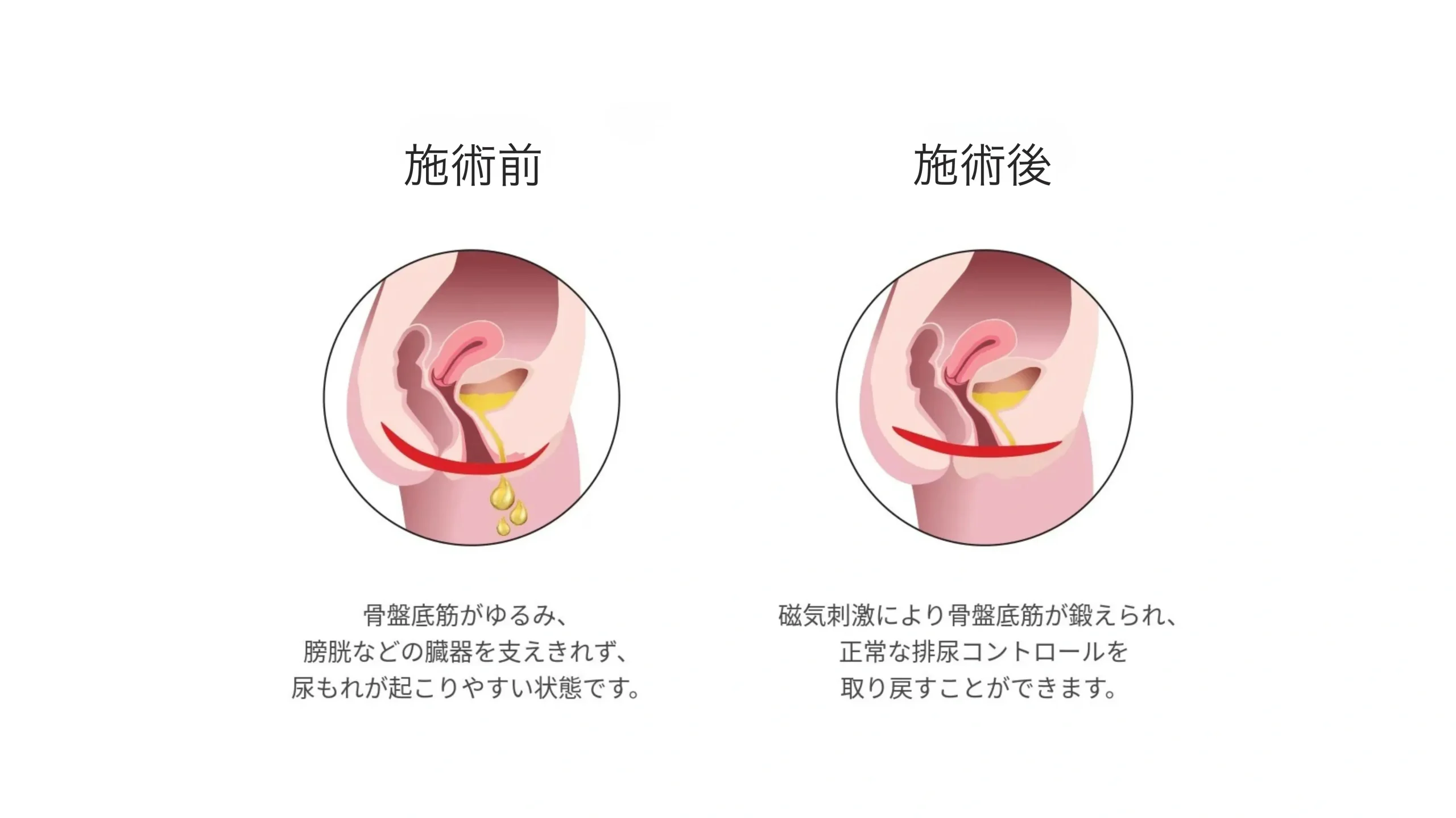 スターフォーマーによる尿もれ治療（骨盤底筋強化・磁気刺激療法）の施術前後比較図